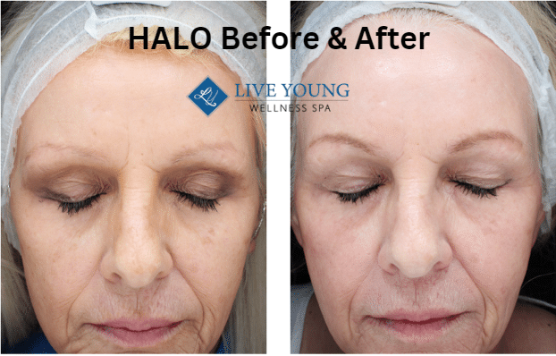 HALO Before & After