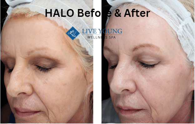 HALO Before & After