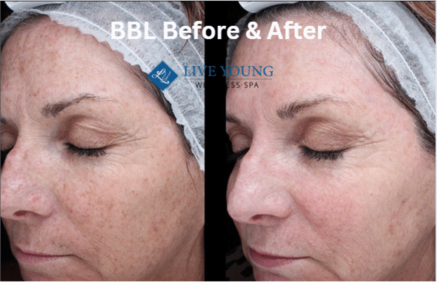BBL Before & After