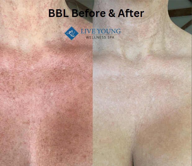BBL Before & After