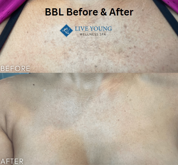 BBL Before & After