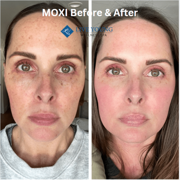 MOXI Before & After