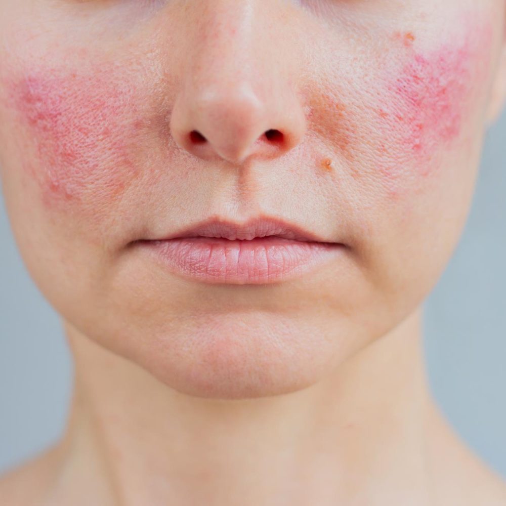 Rosacea