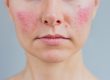 Rosacea