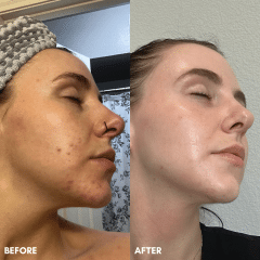 BBL, ClearSilk, VI Chemical Peel