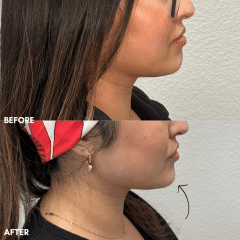 Chin Filler