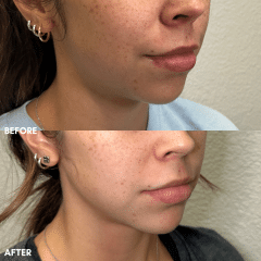 Chin + Jaw Filler