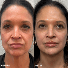 Full Facial Balancing