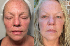 OLD LYWS Before & After - 2025-11-17-HALO-01