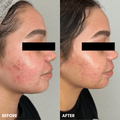 Hydrating Facial+ Microneedling