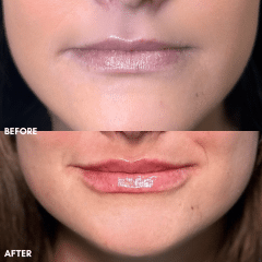 Lip Filler