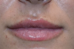 Lip Filler After 09