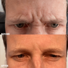Neuromodulators (Botox, Dysport, Daxxify)