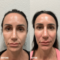 Sculptra + Filler
