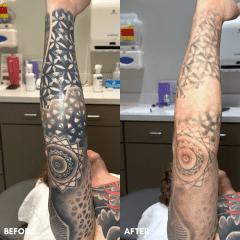 Tattoo Removal