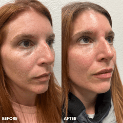 Tear Trough + Lip Filler