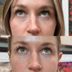 Under Eye Rejuvenation