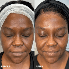 VI Chemical Peel